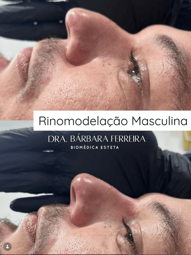 Rinomodelação - Dra. Bárbara Ferreira, Biomédica Esteta